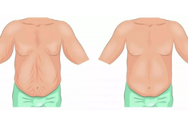 Loose Skin Removal