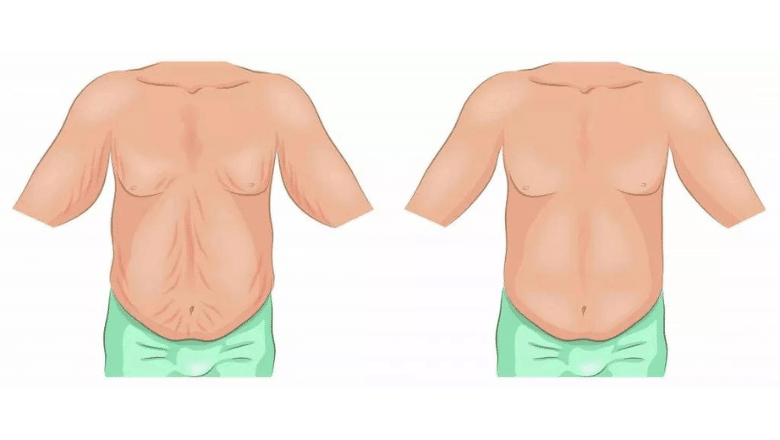Loose Skin Removal