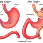 Mini Gastric Bypass