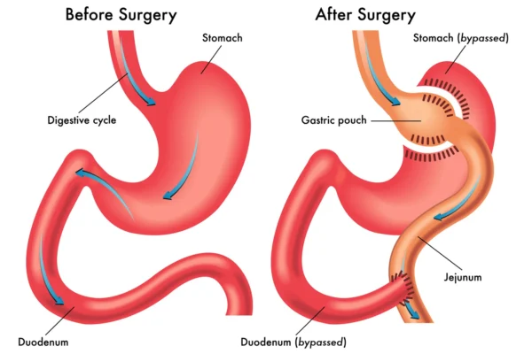 Mini Gastric Bypass