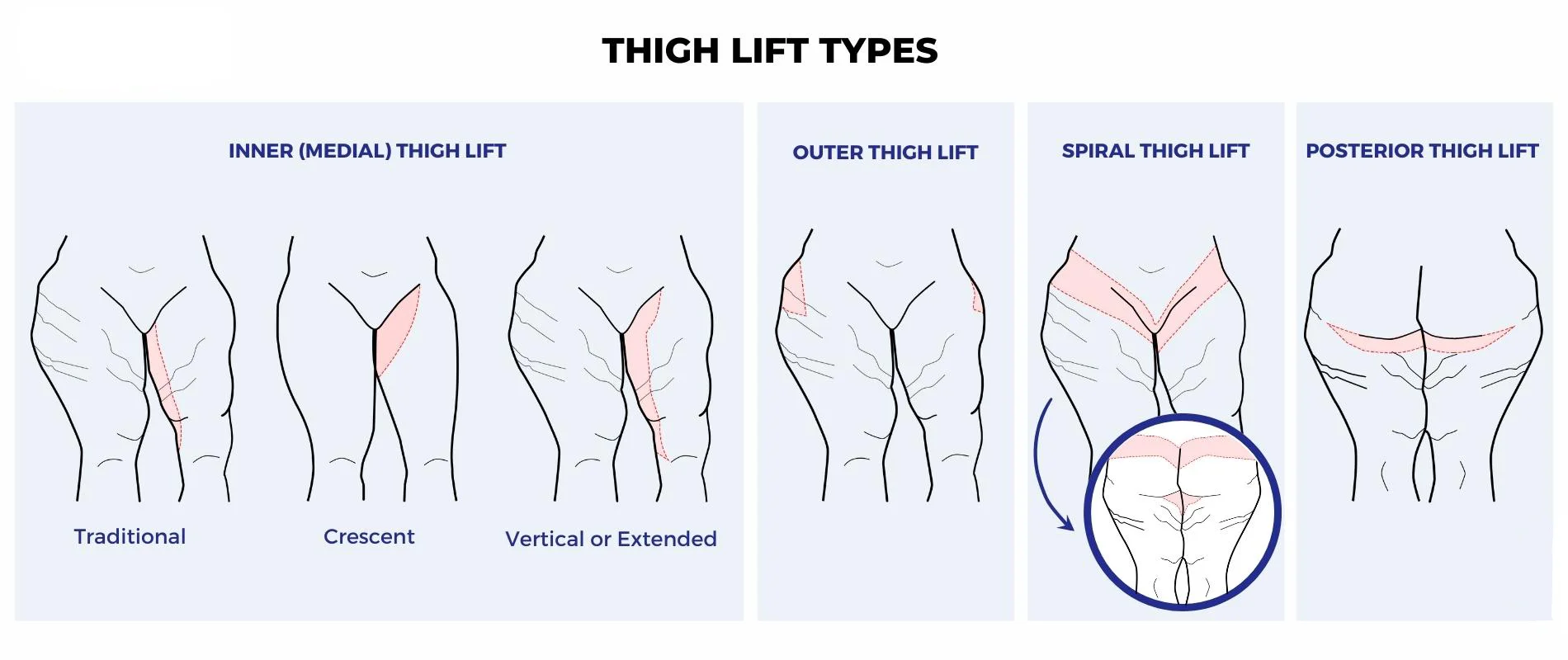 Thigh Lift Surgery Incisions and Types