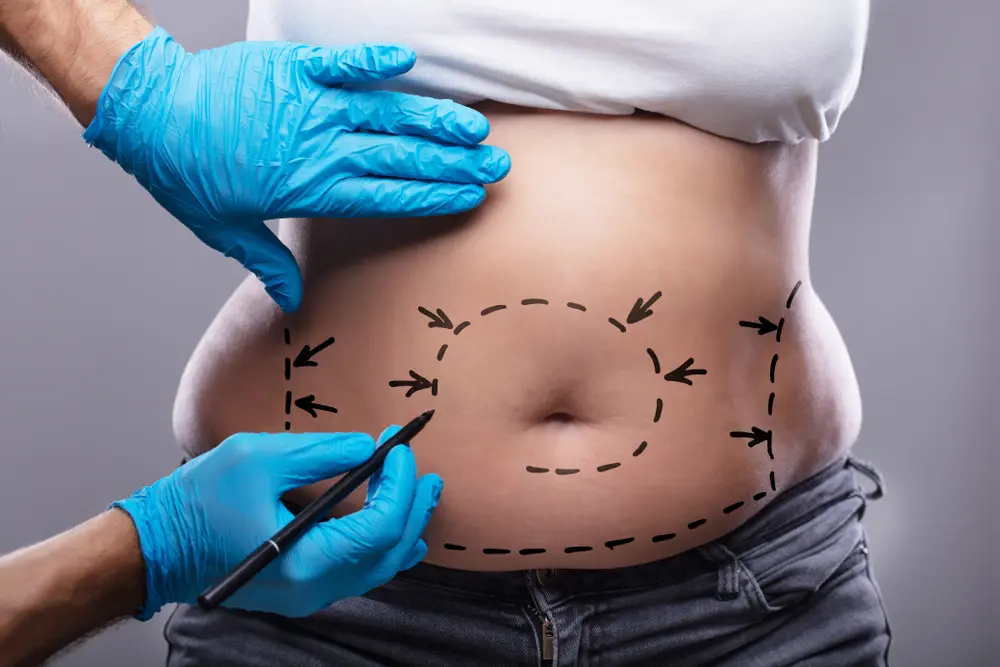 Belly Button Liposuction: Treatment Areas, Procedure, Recovery