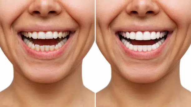 Composite Veneers: Application, Longevity, and Comparison with Porcelain