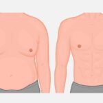 Grade 2 & 2B Gynecomastia