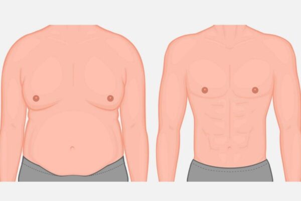 Grade 2 & 2B Gynecomastia