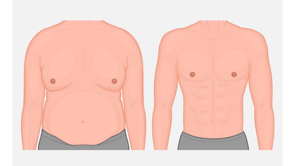 Grade 2 & 2B Gynecomastia