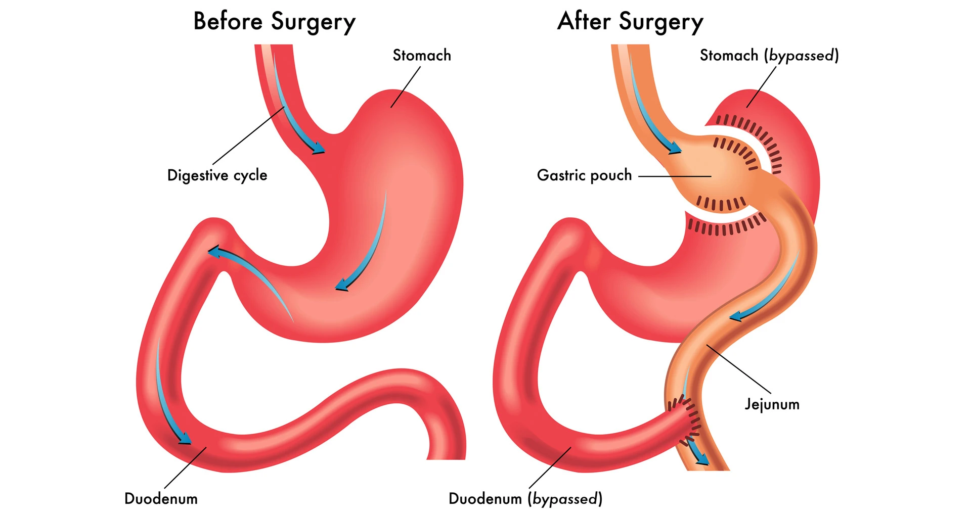 Mini Gastric Bypass: Success Rates, Risks, and Complications