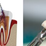 Root canal vs Extraction