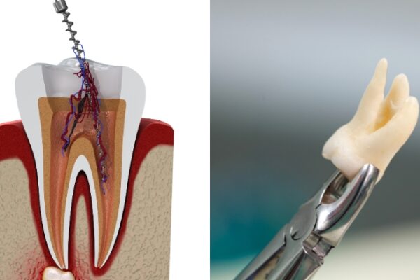 Root canal vs Extraction