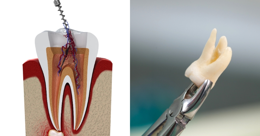 Root Canal vs. Extraction: Procedure, Criteria, Cost & Recovery