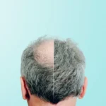 2nd Hair Transplant