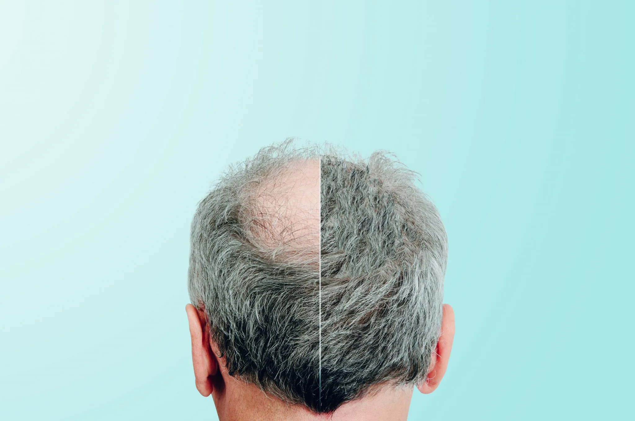 2nd Hair Transplant