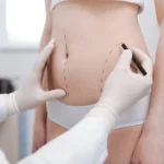 BMI Requirements for Tummy Tuck Surgery