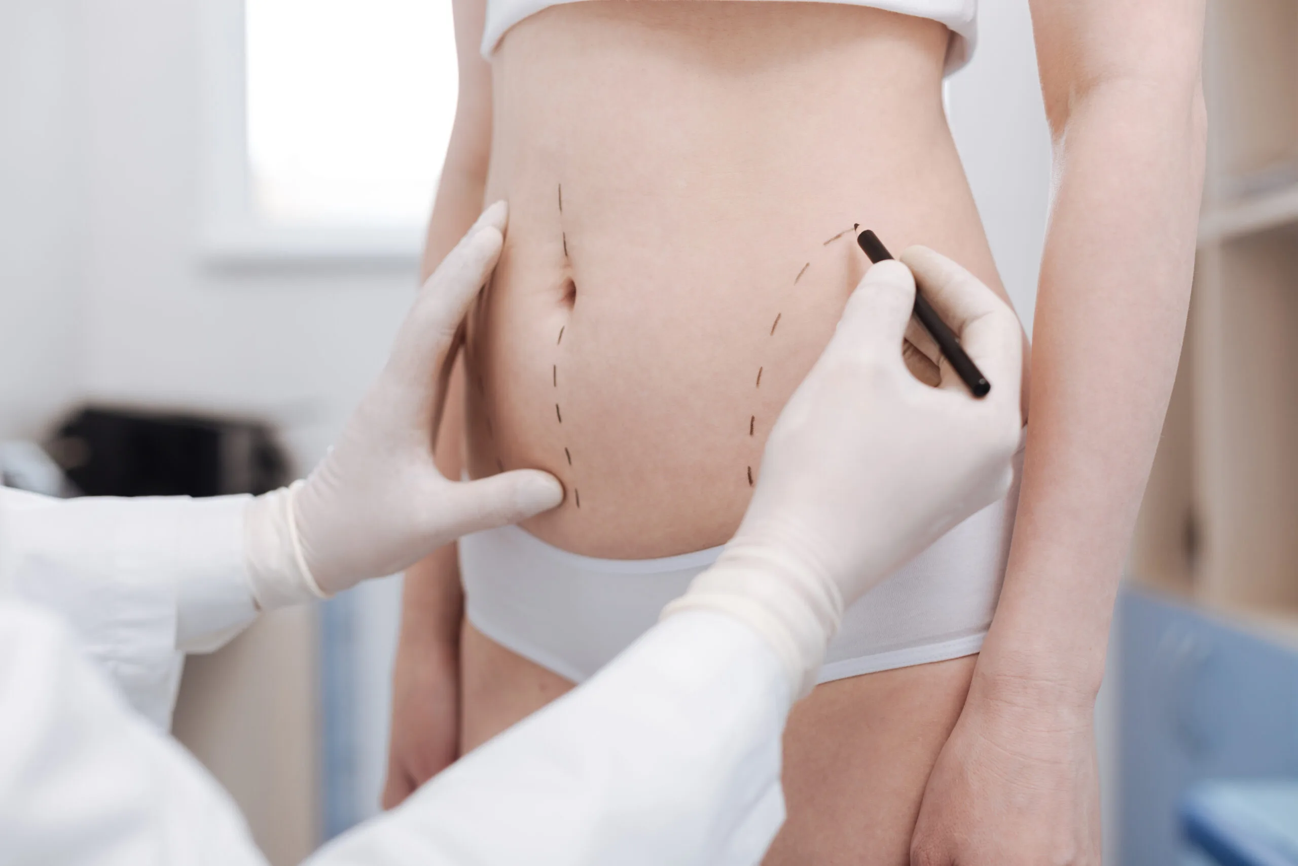 BMI Requirements for Tummy Tuck Surgery