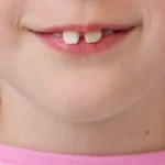 Buck Teeth Causes and Types