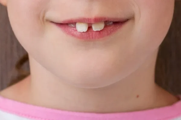 Buck Teeth Causes and Types
