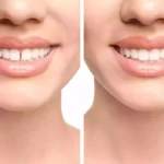Diastema