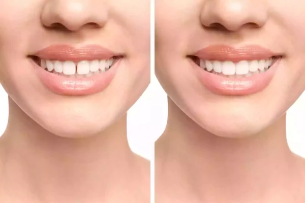 Diastema