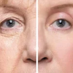 Eyelid Surgery