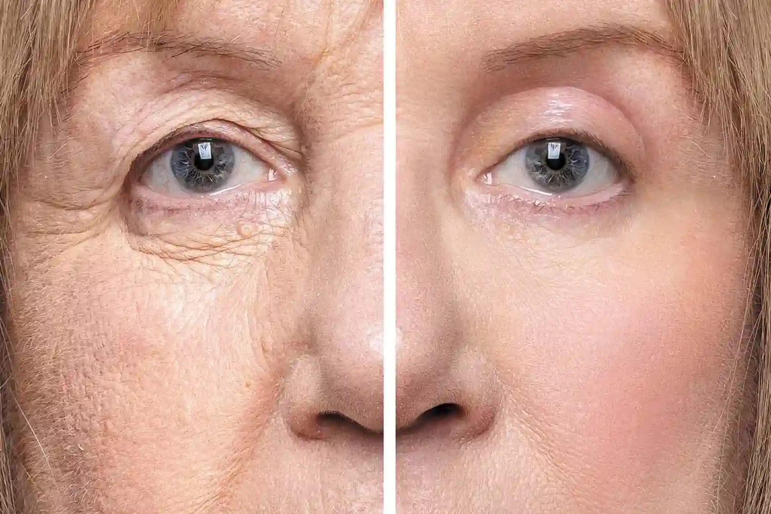 Eyelid Surgery