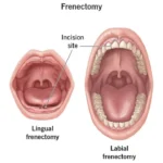 Frenectomy Surgery