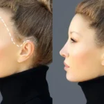 Hair Transplants for Forehead Reduction