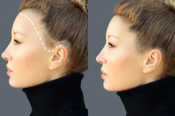 Hair Transplants for Forehead Reduction