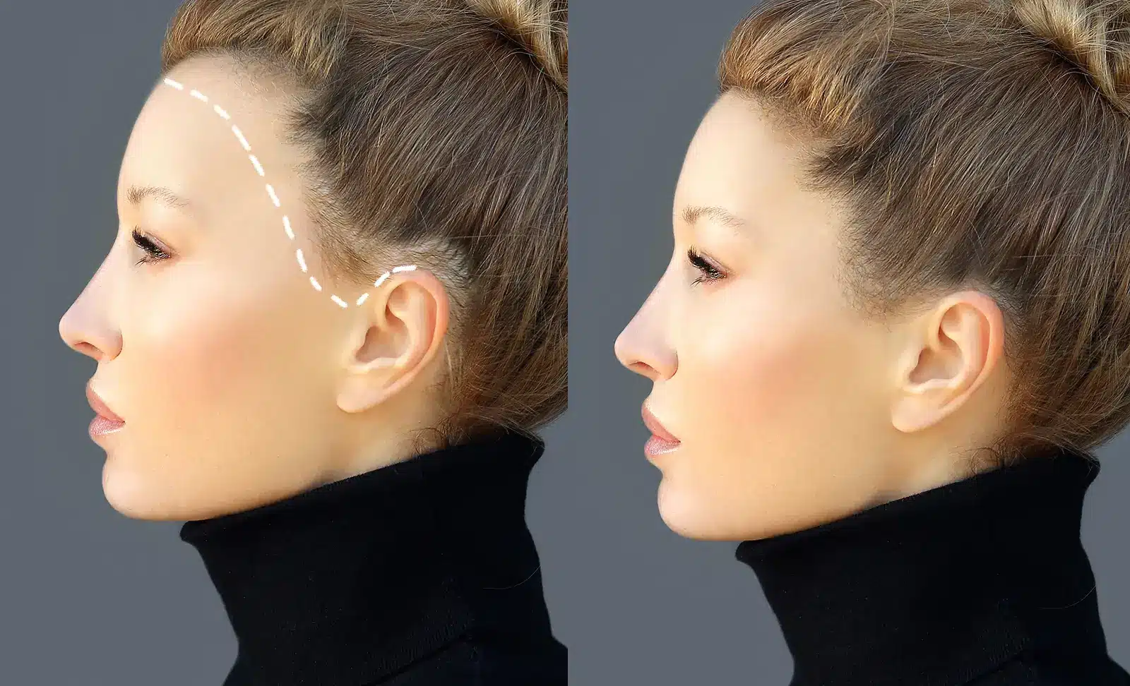 Hair Transplants for Forehead Reduction