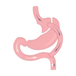 Laparoscopic Roux-en-Y Gastric Bypass Surgery