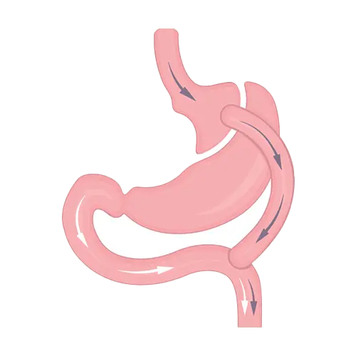 Laparoscopic Roux-en-Y Gastric Bypass Surgery