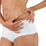 Liposuction Risks