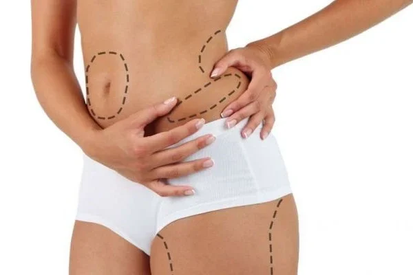 Liposuction Risks