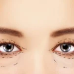 Lower Lid Blepharoplasty Techniques