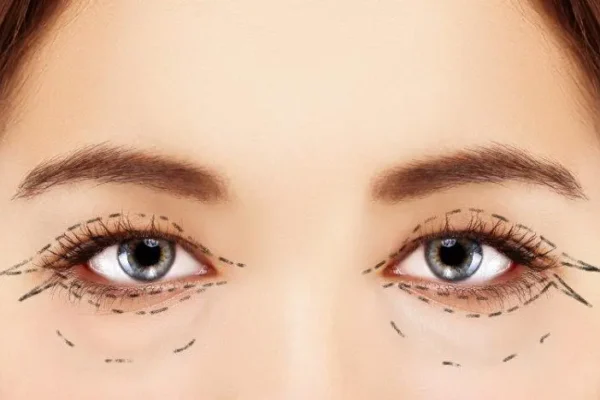 Lower Lid Blepharoplasty Techniques
