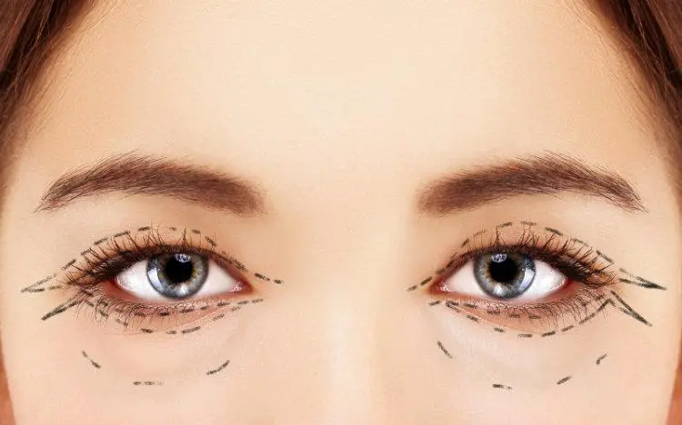 Lower Lid Blepharoplasty Techniques