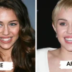 Miley Cyrus Teeth Transformation
