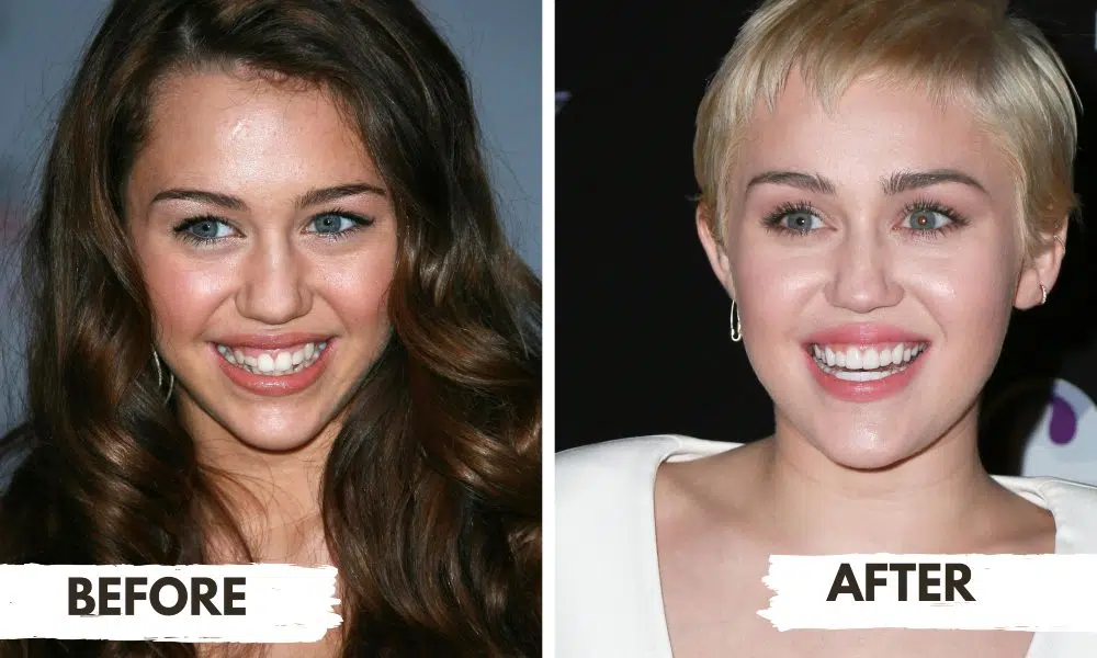 Miley Cyrus Teeth Transformation