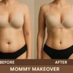 Mommy Makeover