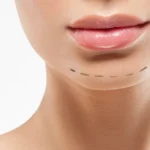 Sliding Genioplasty Before and After