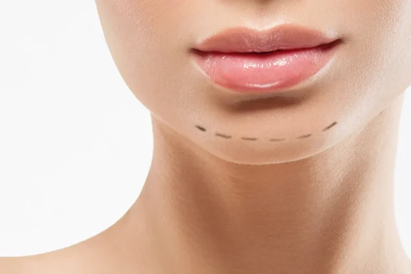 Sliding Genioplasty Before and After