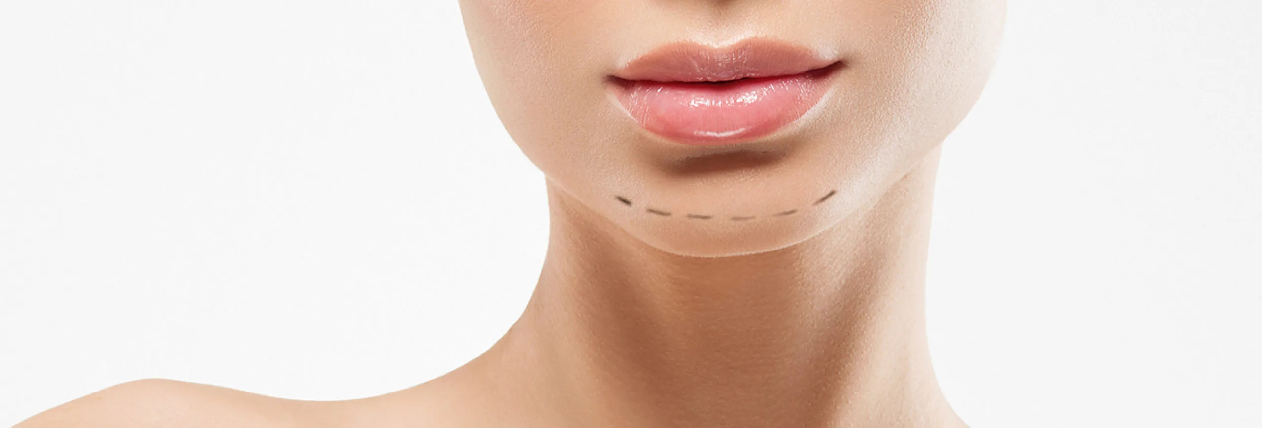 Sliding Genioplasty Before and After