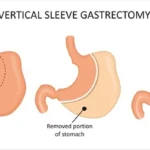 Vertical Gastric Sleeve Safety