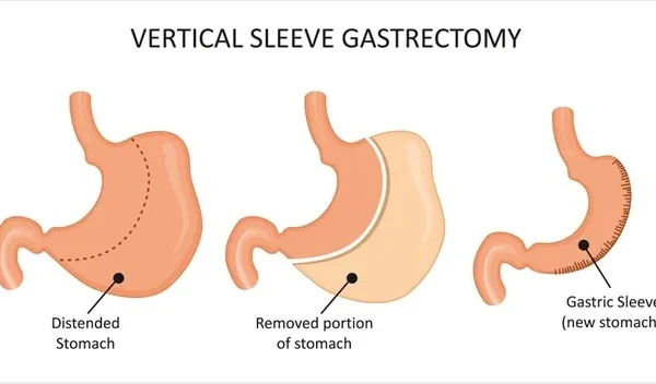 Vertical Gastric Sleeve Safety