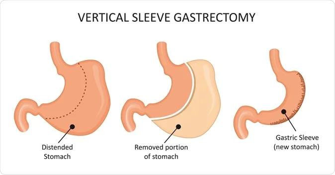 Vertical Gastric Sleeve Safety