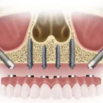 Zygomatic Implants