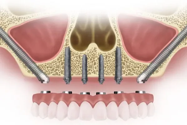 Zygomatic Implants