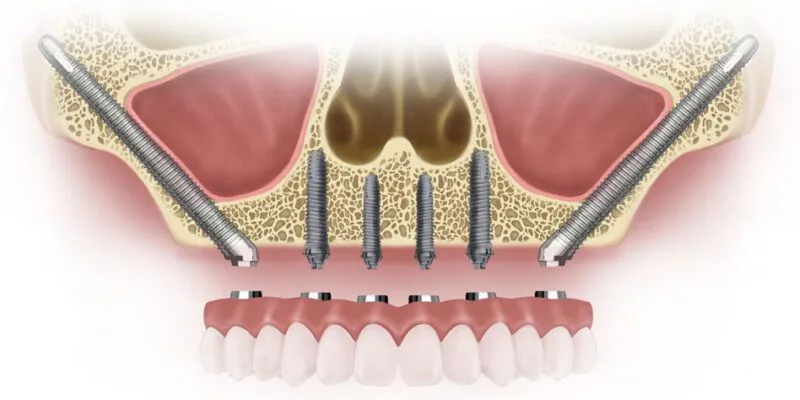 Zygomatic Implants