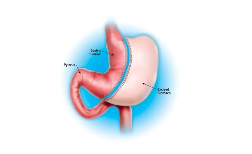 Anatomy Behind Gastric Sleeve: How Do You Lose Weight?