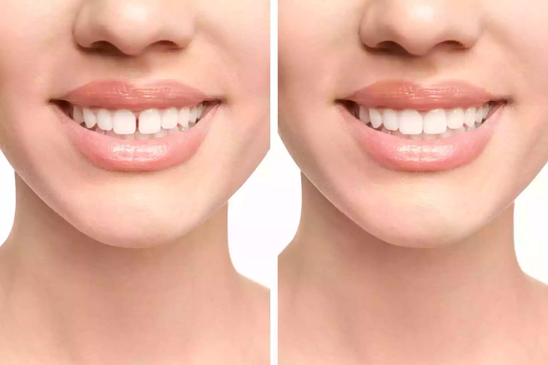 Diastema: Causes, Types and Treatment Solutions