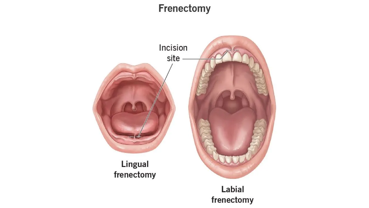 Frenectomy Surgery: What It Is, Methods, and Treatment